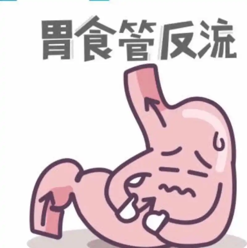 胃食管反流病( 胃食管反流病(