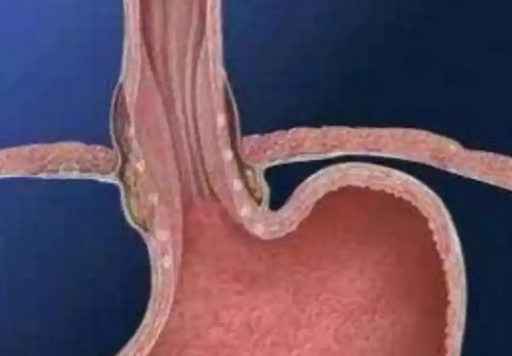 反流性食管炎 反流性食管炎