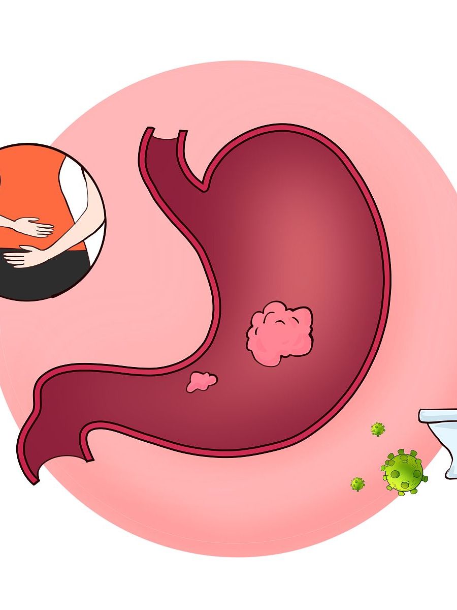 急性胃炎 急性胃炎